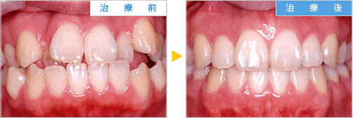 写真：矯正治療の経過