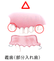 義歯（部分入れ歯）