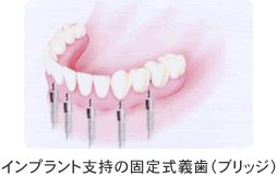 インプラント支持の固定式義歯（ブリッジ）