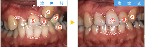 歯科矯正の治療例