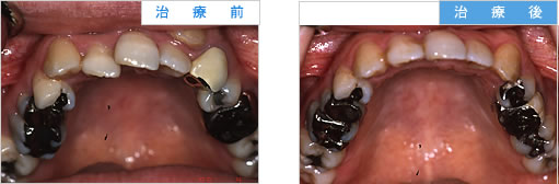 歯科矯正の治療例