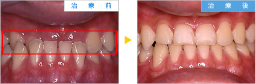 若年層の歯科矯正の治療例