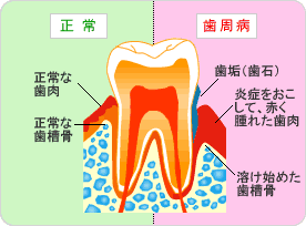 歯周病について